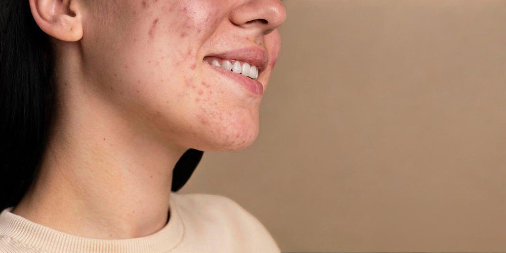 Blemish Treatment and Glowing Skin: How to Combat Dark Spots