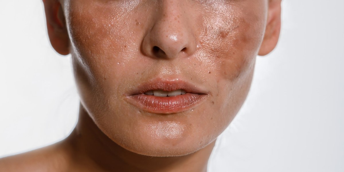 Hyperpigmentation: A Comprehensive Guide📘