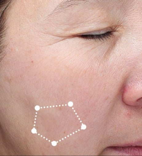 dark spot treatment before after
