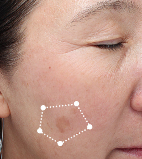 dark spot on a woman's face before using ENLIGHTEN