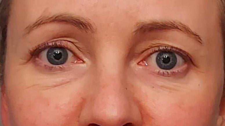 After Luminance Eye patch