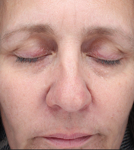 Luna Microcare-revive-before-after