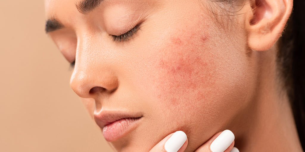 Advanced Solutions for Post-Acne Concerns
