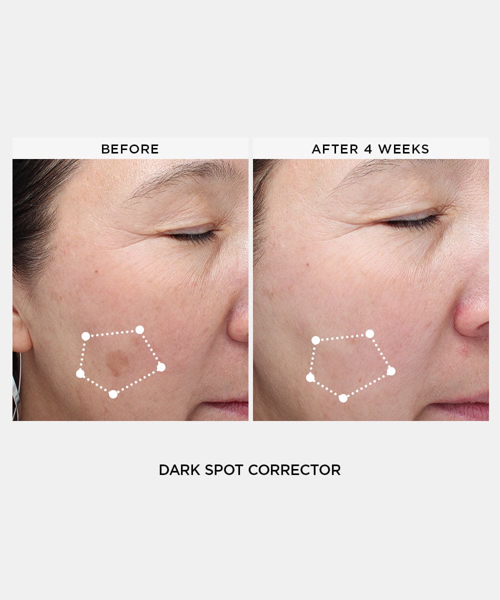 dark spot treatment before after